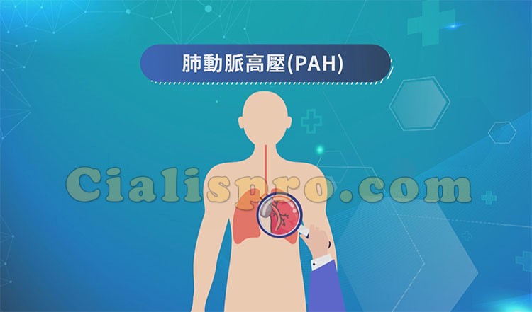 什麼是肺動脈高壓（PAH）？